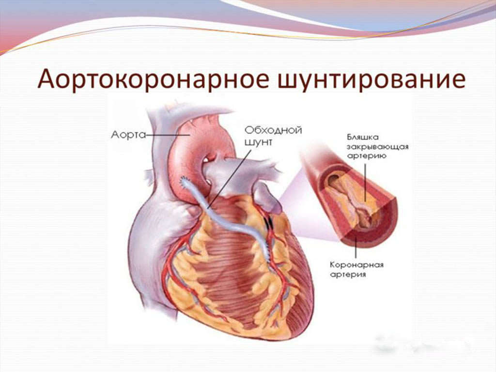 Схема аортокоронарного шунтирования