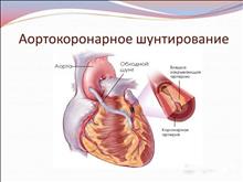 Аортокоронарное шунтирование 